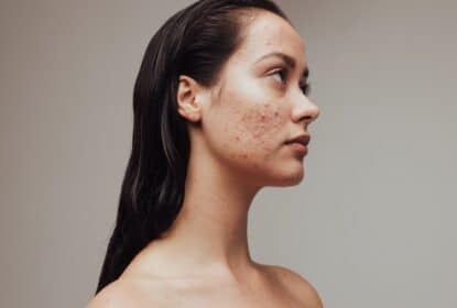 J’ai de l’acné adulte : l’Hydrafacial est-il efficace ? | Dr Luneau | Aix en Provence