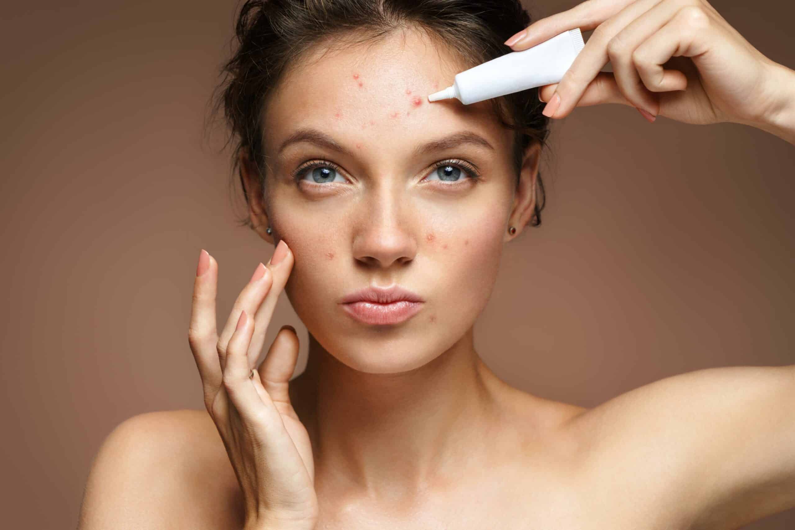 Traitement de l'acné du visage | Dr Christine Luneau | Aix-en-Provence