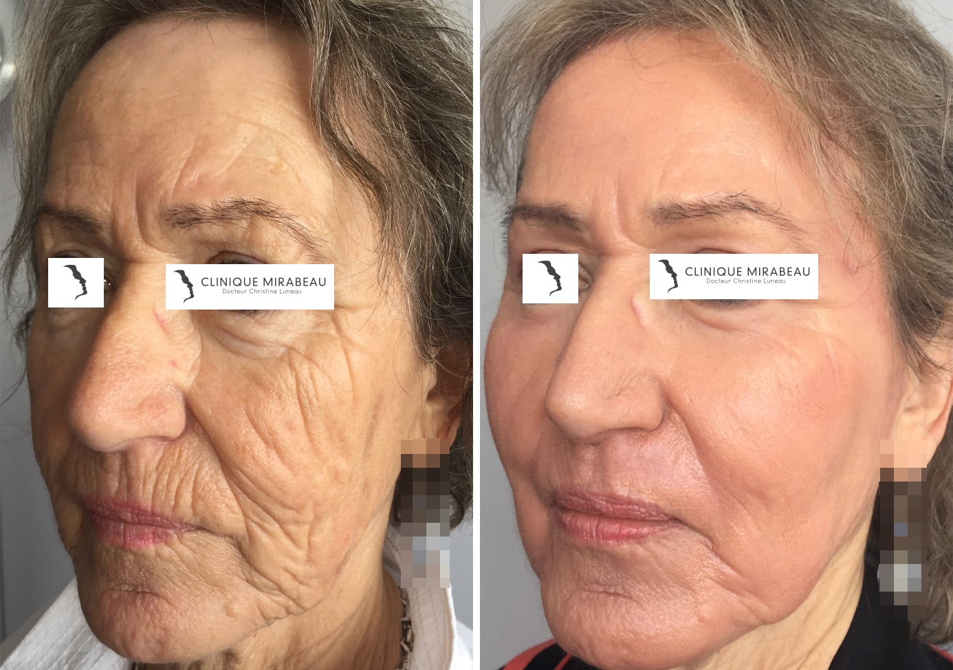 Peeling profond : traitement | Dr Christine Luneau | Aix-en-Provence