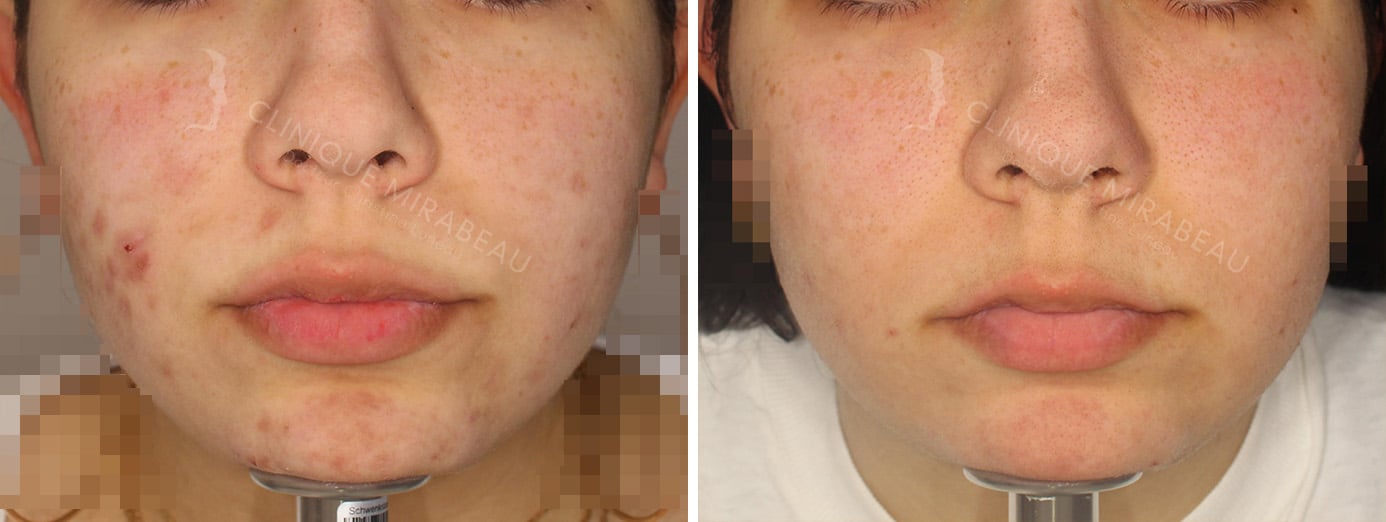 J'ai de l'acné : traitement | Dr Christine Luneau | Aix-en-Provence